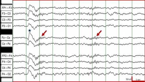 Short, rhythmic bursts of brainwave activity that appear during stage 2 sleep are called
