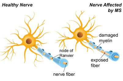Multiple sclerosis (ms) is a disease that affects the nerve cells of the brain and the spinal cord.