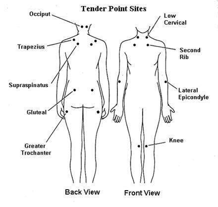 Trigger points, areas on a patient's body that are tender to touch and feel firm, are indicative of