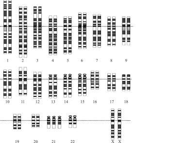 Karyotype the karyotype above shows a a) healthy male. b) male with turner syndrome. c) healthy fem