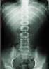 How does a normal spine appear on an x-ray