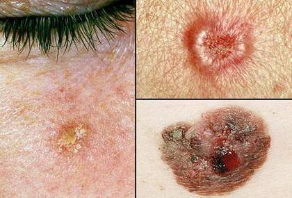 What is skin cancer and how does it occur?