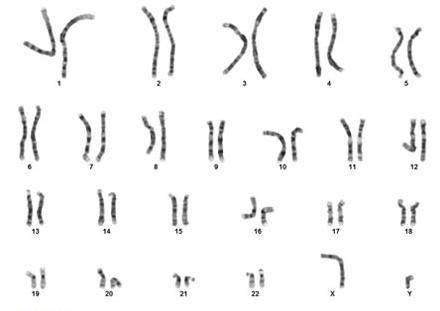 Describe an individual with the karyotype shown. A. a female with Turner's syndrome B. a male with K