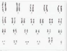 Describe an individual with the karyotype shown. A. a female with Turner's syndrome B. a male with K