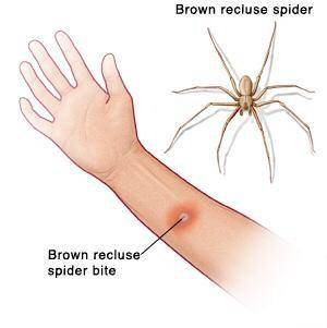 23 points
Show a picture of what both a brown recluse spider bite and spider looks like!!