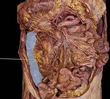 Which region of the colon is highlighted? a) descending b) sigmoid c) ascending d) transverse