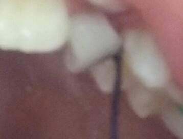 Ineed removing my tooth! should i just yank it out?