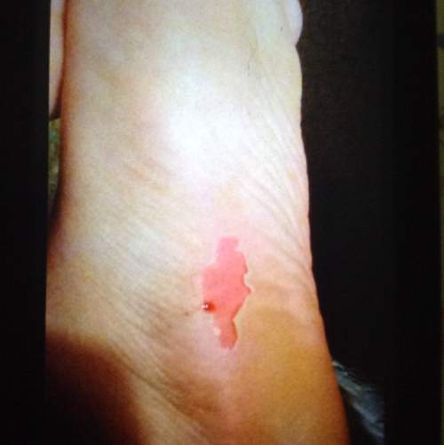 What should i do if i have blister now?  i tore off the blister skin from my left foot and it