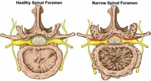 Arthritis and other similar diseases can cause a narrowing of the spinal foramen. The images below s