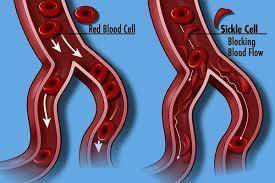 What is the effect of sickle cell anemia