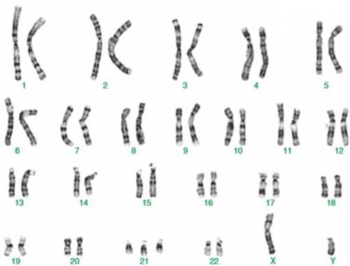 In this karyotype, identify the syndrome associated with the chromosomal change in the karyotype and