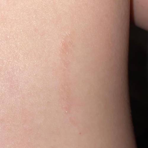 What type of scar is this? Apparently had it since I was a baby. It’s rough and sometimes it peels a