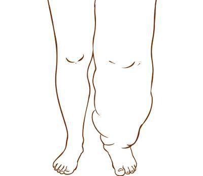 Type your response in the box. Lymphedema is caused by an excess of lymph in the body tissues. The c