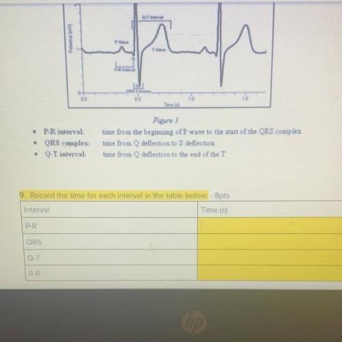 PLEASE HELP ME WITH THID EKG READING :((