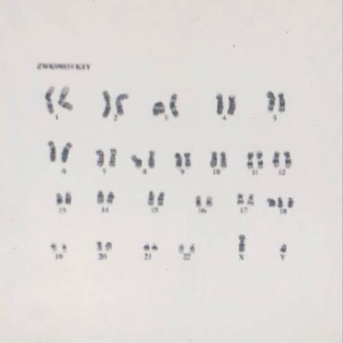 What is unique about this karyotype? Male or female? Explain. What types of disorders do you see on