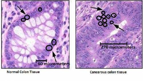 The image above compares the structure of normal colon tissue with cancerous colon tissue. Some ind