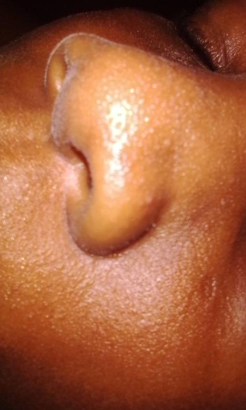 Hi. Can anyone telle what these little bumps ony sisters face are ?

I'm getting worried. And do y