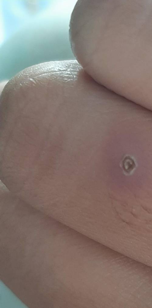 Should my friend be worried? for having this on his fingers