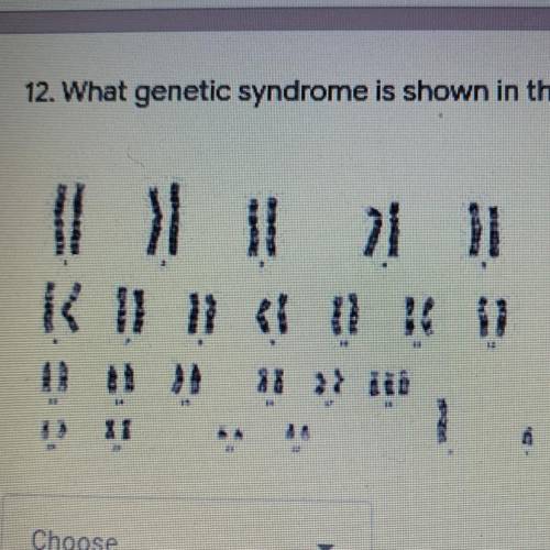 12. What genetic syndrome is shown in this picture? *