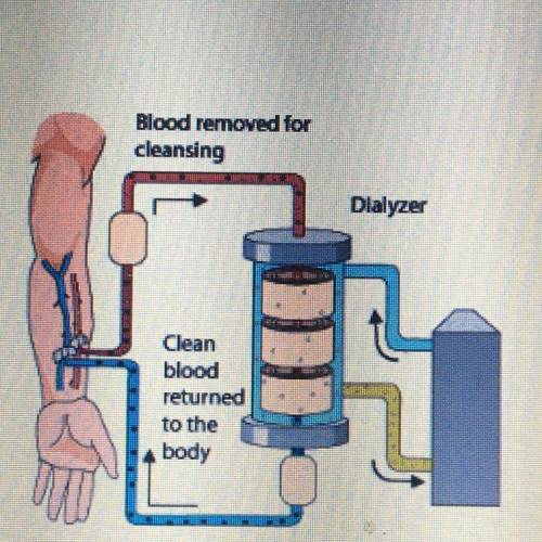 4) People experiencing renal failure (kidney disease) may be forced to use a dialysis machine, wher