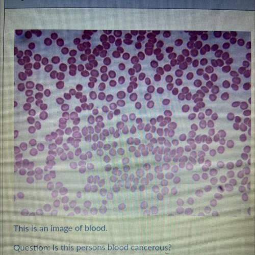 This is an
image of blood.
Question: Is this persons blood cancerous?
