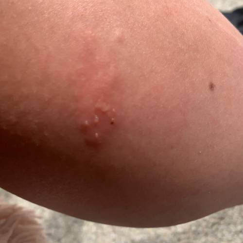 Anyone know what this is? I have not been exposed to poison ivy that I know of. It’s itchy and leak