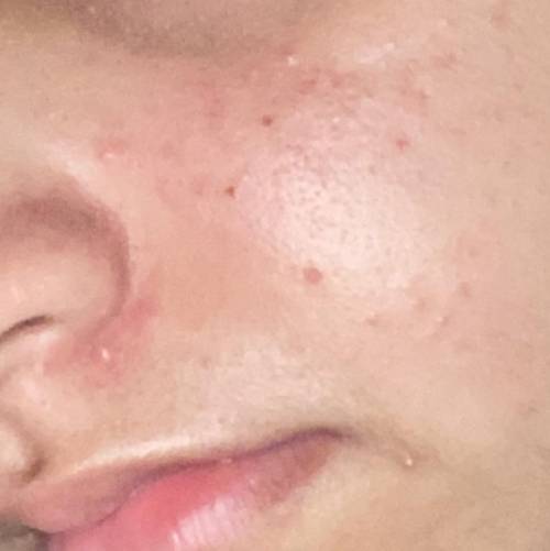 How do I treat this acne thing??? Helppp